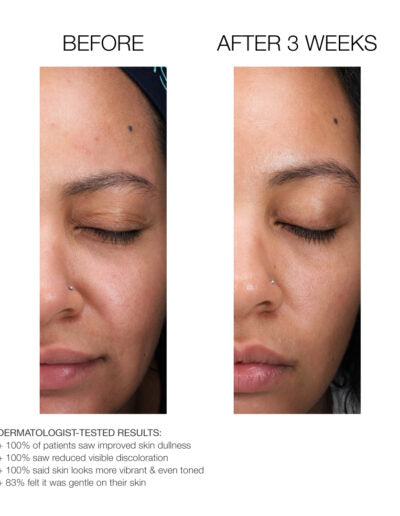 Medical-Grade Lactic Acid Micro-Peel | Retexturing & Hydrating Chemical Exfoliant