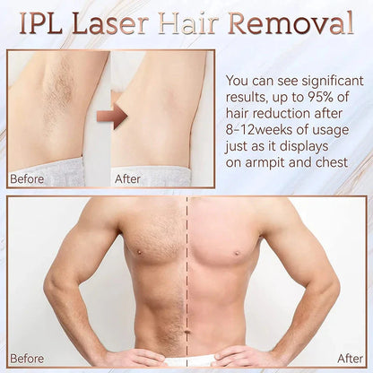 IPL Laser Epilator – Painless Hair Removal Device