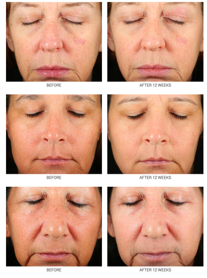 Medical-Grade Retinoid Serum 2.5% & 5% | Advanced Anti-Aging Treatment WRI-LAX 5x