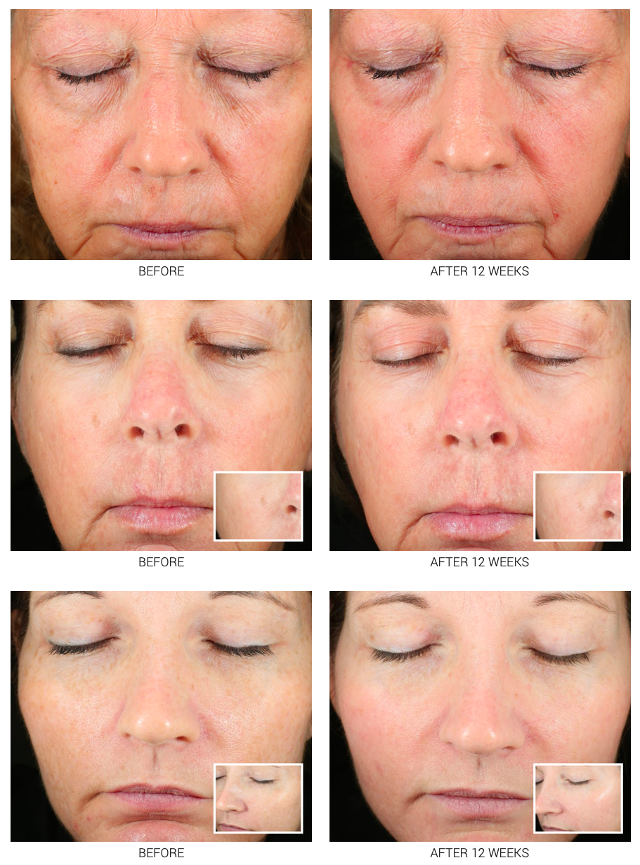 Medical-Grade Retinoid Serum 2.5% & 5% | Advanced Anti-Aging Treatment WRI-LAX 5x