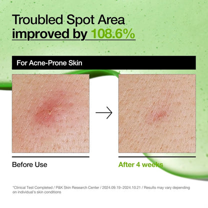 Anua soothing Azelaic Acid 10% Serum with Hyaluronic Acid & Niacinamide for Sensitive Skin - Korean Skincare for Breakouts & Redness Relief (30ml)