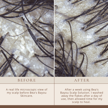 YeastDefense®️ Seborrheic Scalp Solution | Herbal Leave-in